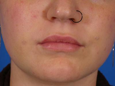 Lip Filler Before & After Gallery - Patient 451515 - Image 2
