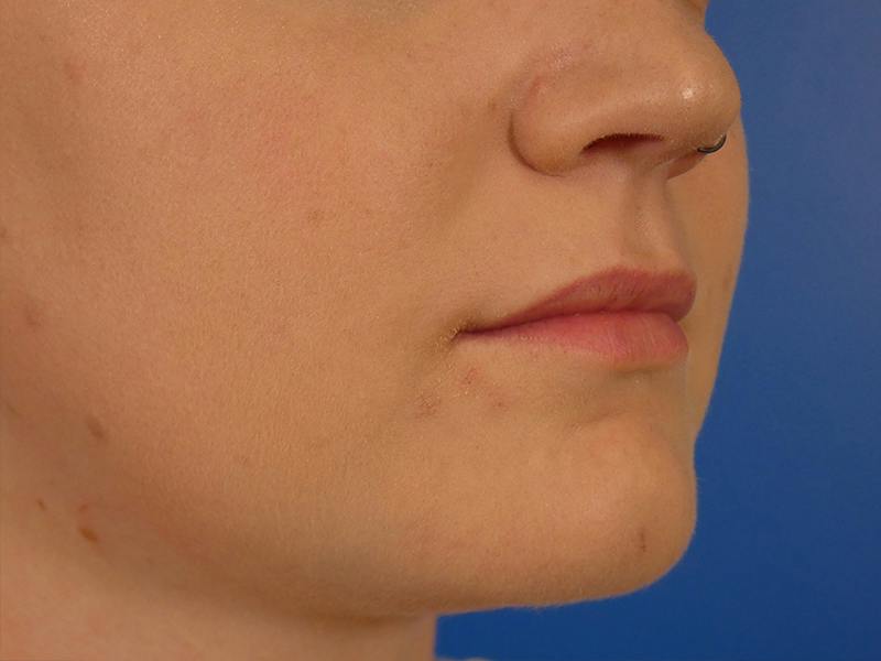 Lip Filler Before & After Gallery - Patient 451515 - Image 3