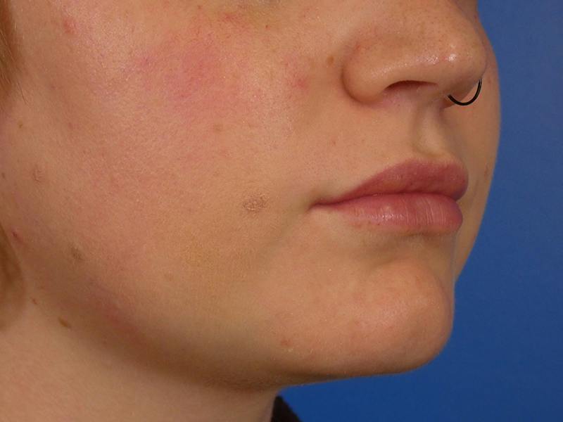Lip Filler Before & After Gallery - Patient 451515 - Image 4