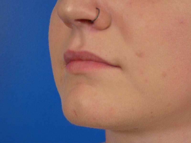 Lip Filler Before & After Gallery - Patient 451515 - Image 5