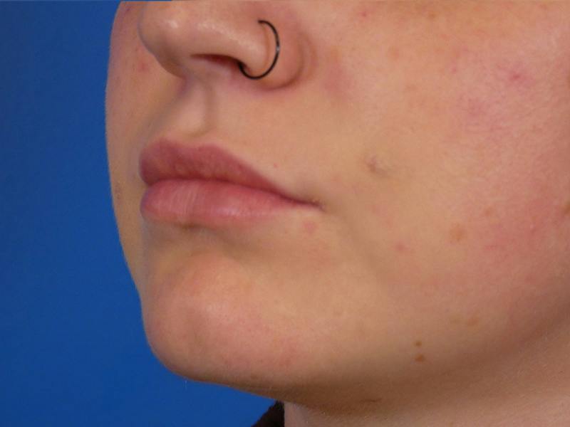 Lip Filler Before & After Gallery - Patient 451515 - Image 6