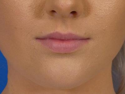 Lip Filler Before & After Gallery - Patient 190100 - Image 1