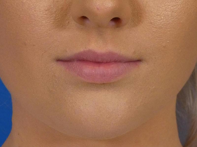 Lip Filler Before & After Gallery - Patient 190100 - Image 1