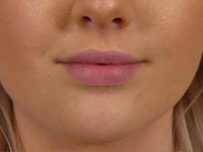 Lip Filler Before & After Gallery - Patient 190100 - Image 2