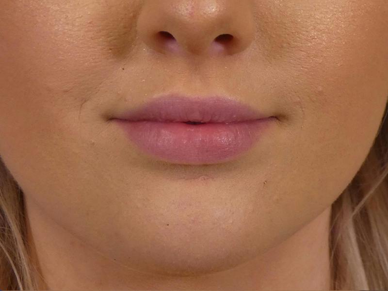 Lip Filler Before & After Gallery - Patient 190100 - Image 2