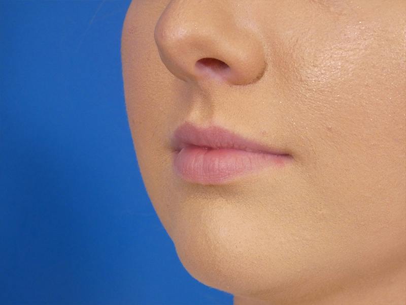 Lip Filler Before & After Gallery - Patient 190100 - Image 3