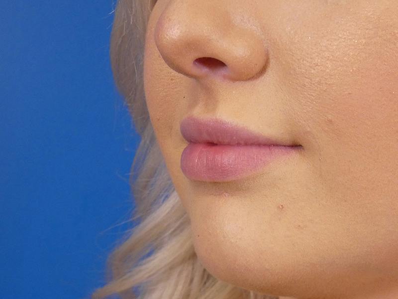 Lip Filler Before & After Gallery - Patient 190100 - Image 4