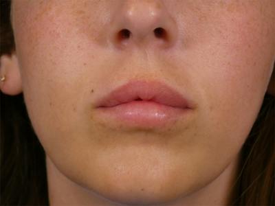 Lip Filler Before & After Gallery - Patient 899929 - Image 1