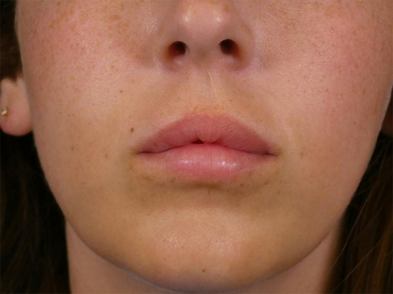 Lip Filler Before & After Gallery - Patient 899929 - Image 1