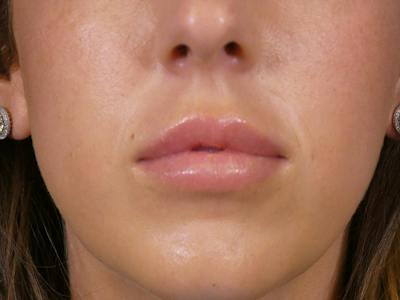 Lip Filler Before & After Gallery - Patient 899929 - Image 2