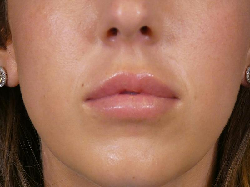 Lip Filler Before & After Gallery - Patient 899929 - Image 2