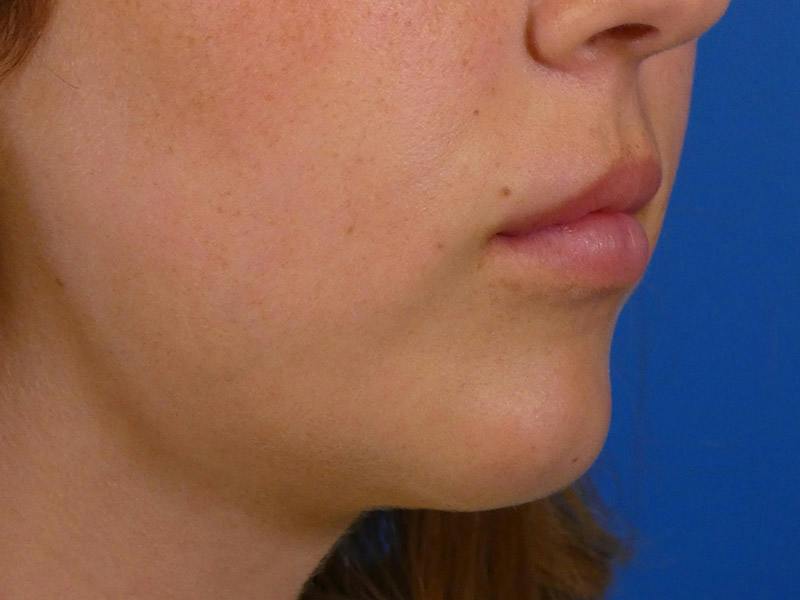 Lip Filler Before & After Gallery - Patient 899929 - Image 3