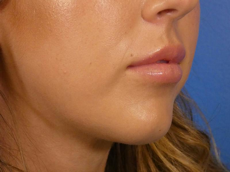 Lip Filler Before & After Gallery - Patient 899929 - Image 4