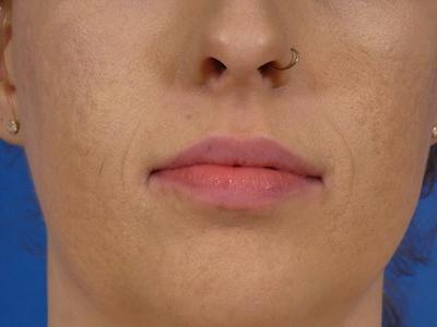 Lip Filler Before & After Gallery - Patient 146566 - Image 1
