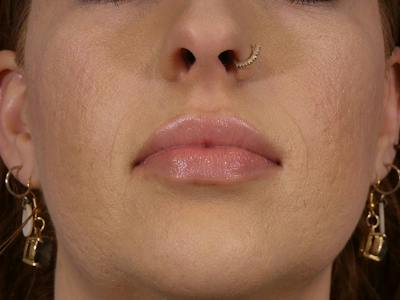 Lip Filler Before & After Gallery - Patient 146566 - Image 2