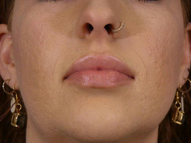 Lip Filler Before & After Gallery - Patient 146566 - Image 2