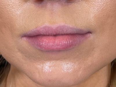 Lip Filler Before & After Gallery - Patient 248066 - Image 1