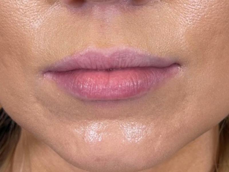 Lip Filler Before & After Gallery - Patient 248066 - Image 1