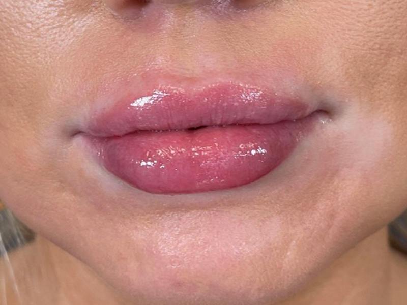 Lip Filler Before & After Gallery - Patient 248066 - Image 2
