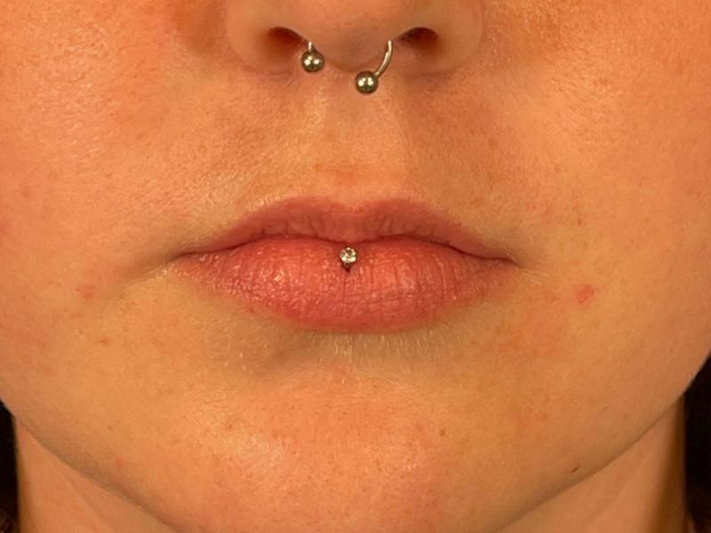 Lip Filler Before & After Gallery - Patient 202556 - Image 1