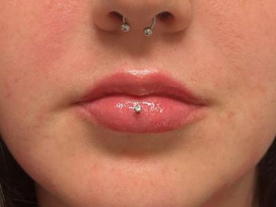 Lip Filler Before & After Gallery - Patient 202556 - Image 2