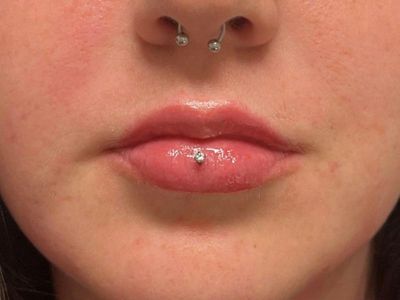 Lip Filler Before & After Gallery - Patient 202556 - Image 2