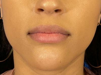Lip Filler Before & After Gallery - Patient 526167 - Image 1