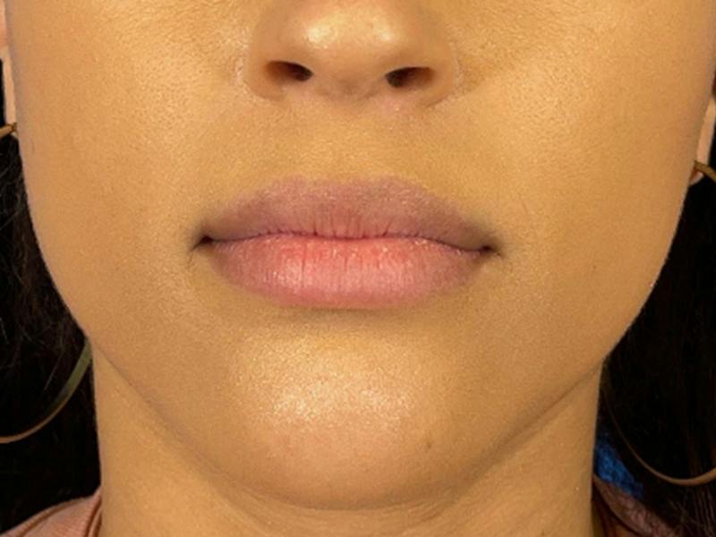 Lip Filler Before & After Gallery - Patient 526167 - Image 1