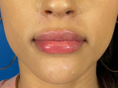 Lip Filler Before & After Gallery - Patient 526167 - Image 2