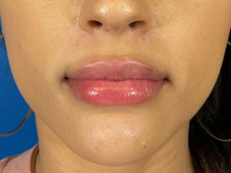 Lip Filler Before & After Gallery - Patient 526167 - Image 2