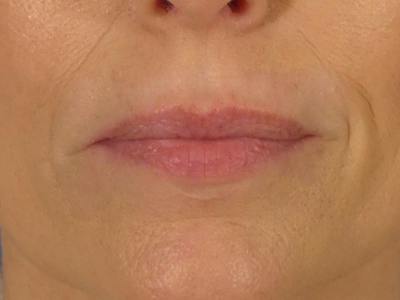 Lip Filler Before & After Gallery - Patient 700713 - Image 1