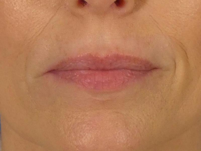 Lip Filler Before & After Gallery - Patient 700713 - Image 1