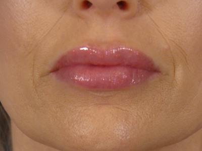 Lip Filler Before & After Gallery - Patient 700713 - Image 2