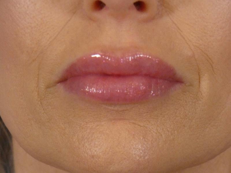 Lip Filler Before & After Gallery - Patient 700713 - Image 2