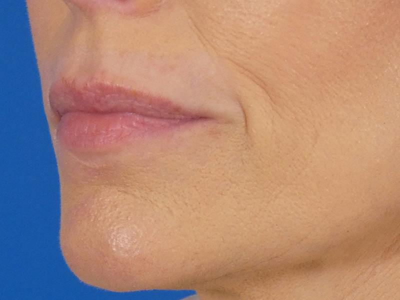Lip Filler Before & After Gallery - Patient 700713 - Image 3