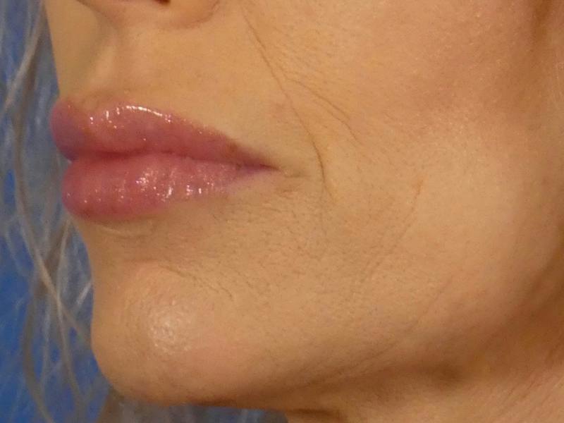 Lip Filler Before & After Gallery - Patient 700713 - Image 4