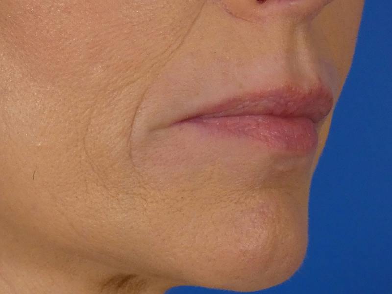 Lip Filler Before & After Gallery - Patient 700713 - Image 5