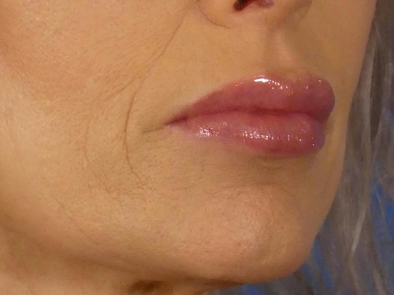 Lip Filler Before & After Gallery - Patient 700713 - Image 6