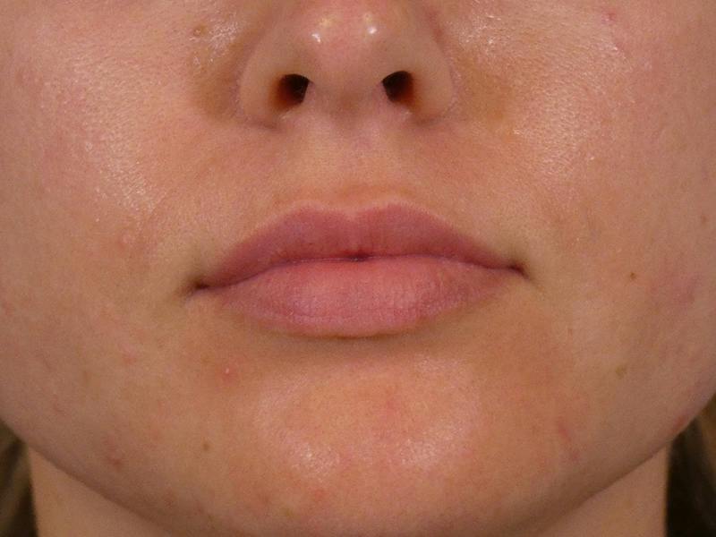 Lip Filler Before & After Gallery - Patient 307004 - Image 1