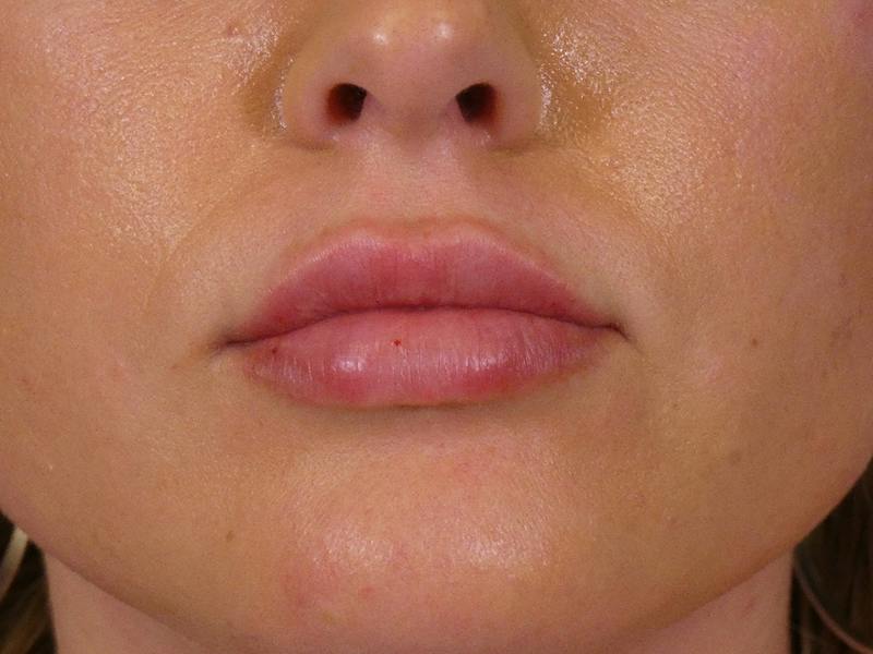 Lip Filler Before & After Gallery - Patient 307004 - Image 2