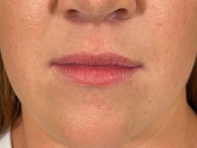 Lip Filler Before & After Gallery - Patient 322617 - Image 1