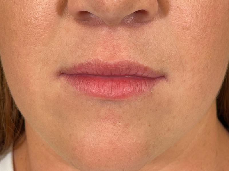 Lip Filler Before & After Gallery - Patient 322617 - Image 1