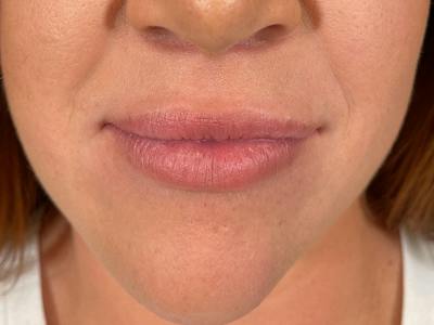 Lip Filler Before & After Gallery - Patient 322617 - Image 2