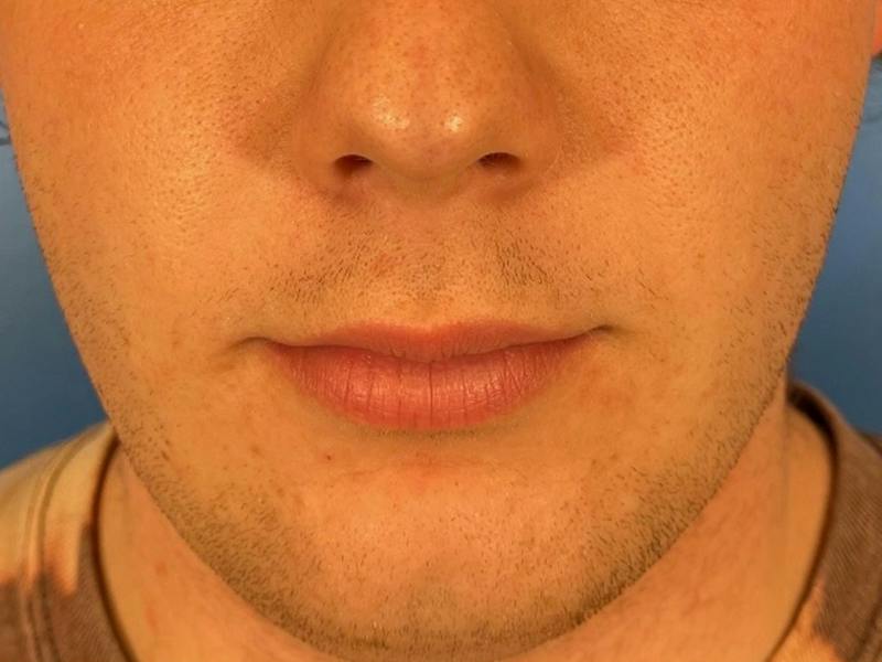 Lip Filler Before & After Gallery - Patient 144622 - Image 1