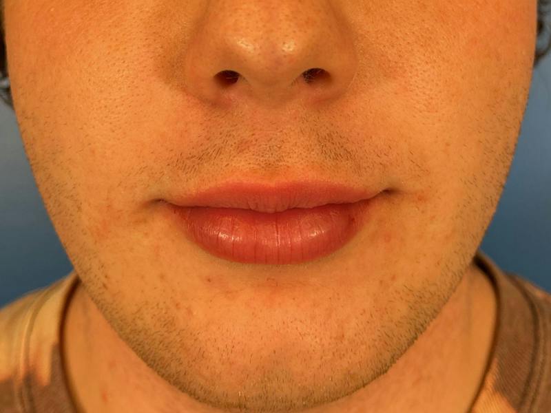 Lip Filler Before & After Gallery - Patient 144622 - Image 2