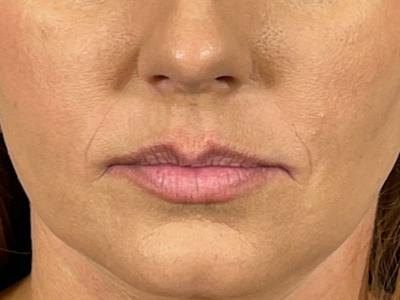 Lip Filler Before & After Gallery - Patient 640000 - Image 1