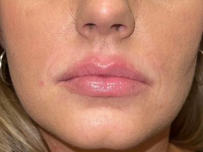 Lip Filler Before & After Gallery - Patient 640000 - Image 2
