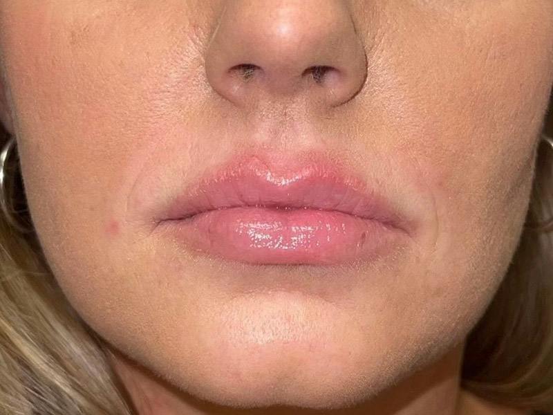 Lip Filler Before & After Gallery - Patient 640000 - Image 2