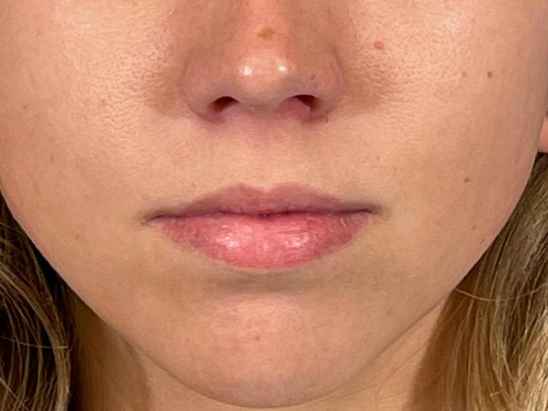 Lip Filler Before & After Gallery - Patient 186274 - Image 1