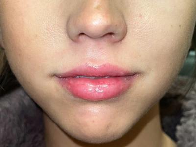 Lip Filler Before & After Gallery - Patient 186274 - Image 2